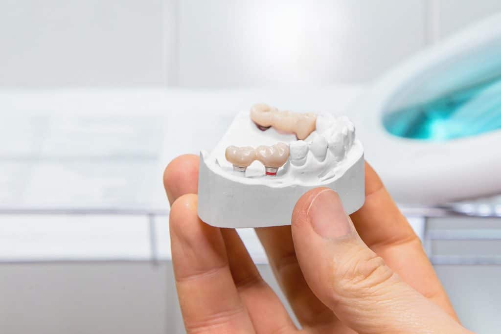 How Much Do Dental Bridges Cost in Nassau County, NY